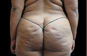 Buttock Augmentation Before & After Patient #1530