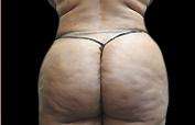 Buttock Augmentation Before & After Patient #1530