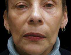 Facelift Before & After Patient #1719