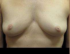 Inverted Nipple Correction Before & After Patient #1872