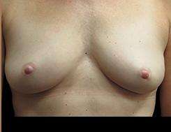 Inverted Nipple Correction Before & After Patient #1872