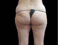 Liposuction Before & After Patient #2187