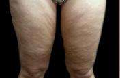 Thigh Lift Before & After Patient #3113