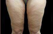 Thigh Lift Before & After Patient #3113