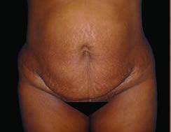 Tummy Tuck Before & After Patient #3366