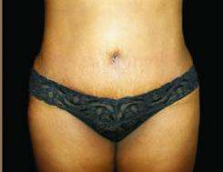 Tummy Tuck Before & After Patient #3366