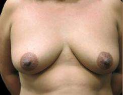 Breast Lift Before & After Patient #1272