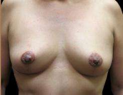 Breast Lift Before & After Patient #1272